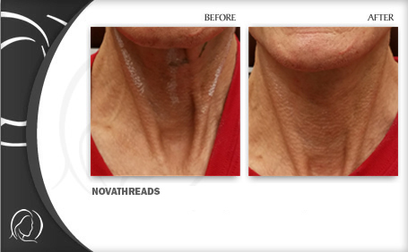 Novathreads - Minars Dermatology