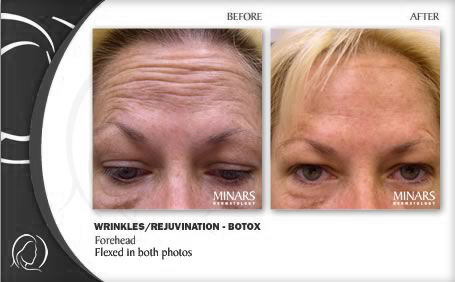 botox treatment before and after botox before and after images