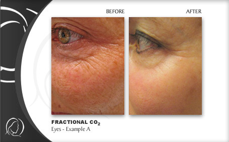 CO2 Laser Facial Rejuvenation: Fix Fine Lines, Wrinkles, Sun Damage &  Stretch Marks