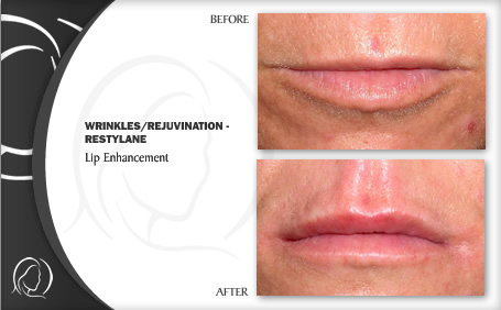 restylane wrinkle filler treatment before and after image examples