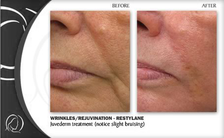 restylane wrinkle filler treatment before and after image examples