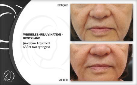 restylane wrinkle filler treatment before and after image examples
