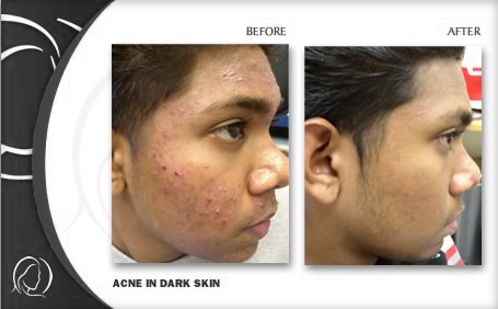 before & after pictures of acne scar treatment on dark skin