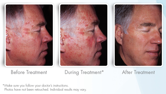 Photodynamic Therapy - Minars Dermatology