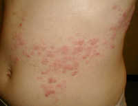 shingles treatment hollywood fl