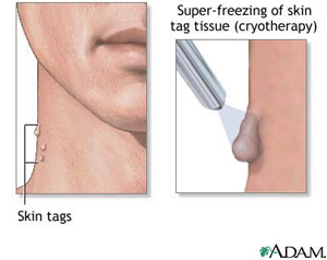 Hollywood FL skin tag removal near you