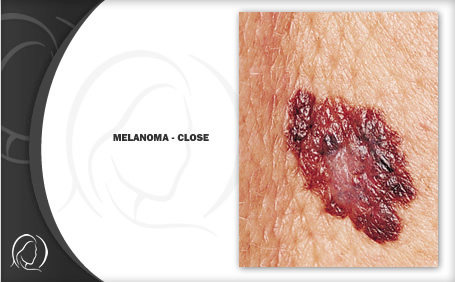Skin Cancer