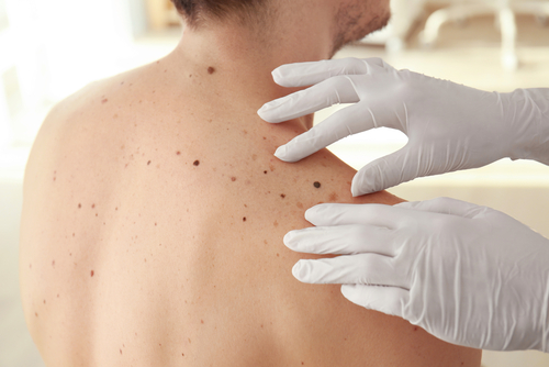 skin tag removal near you in Hollywood FL