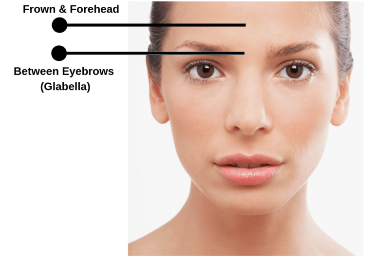 Botox® Pricing Guide How much does Botox cost? Top 4 Areas of Face Forehead, Glabella, Frown
