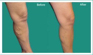 Pin on how to remove varicose veins