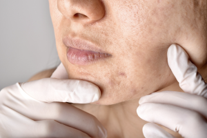 acne scar treatment near you in Hollywood, FL