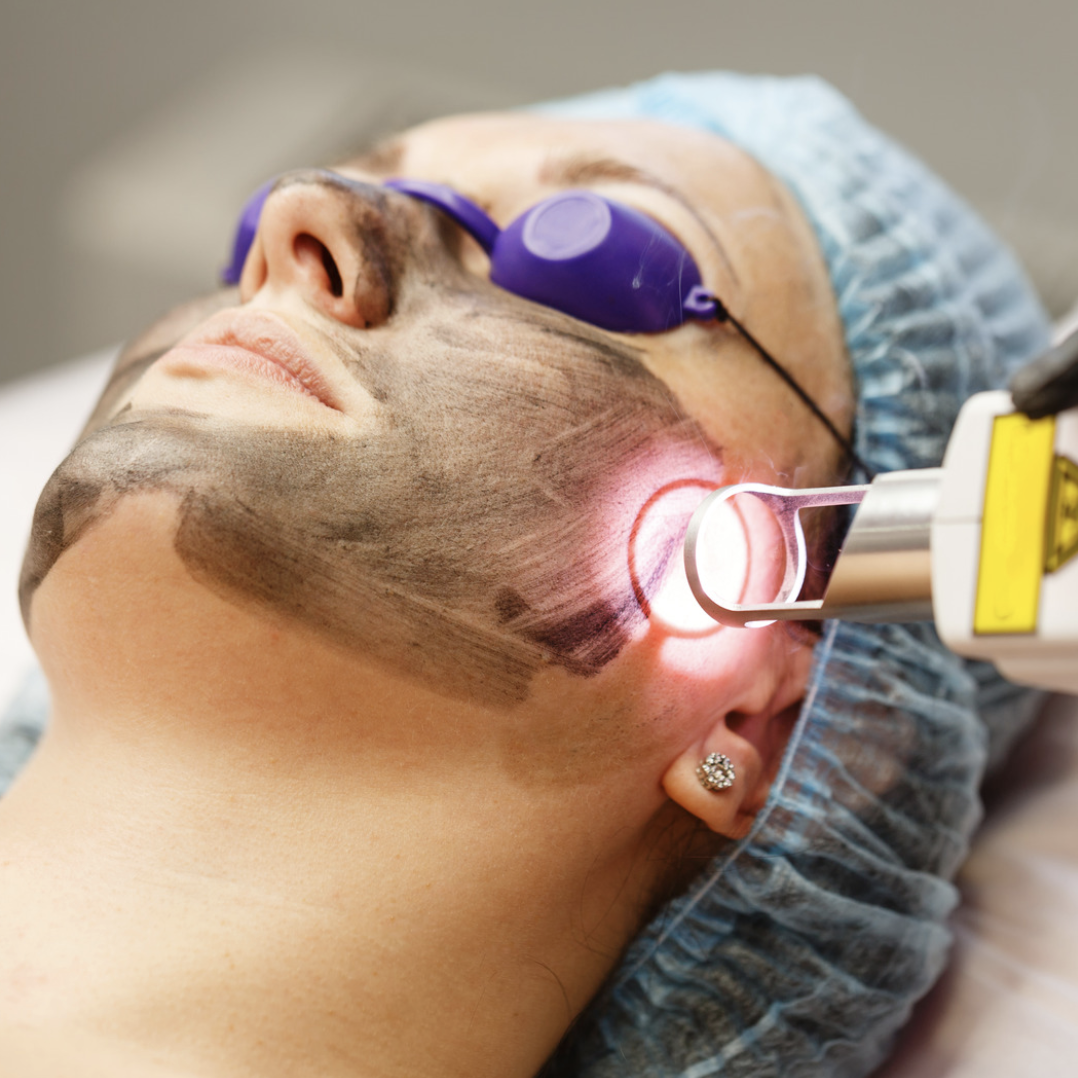 carbon laser acne treatment near you in Hollywood, FL