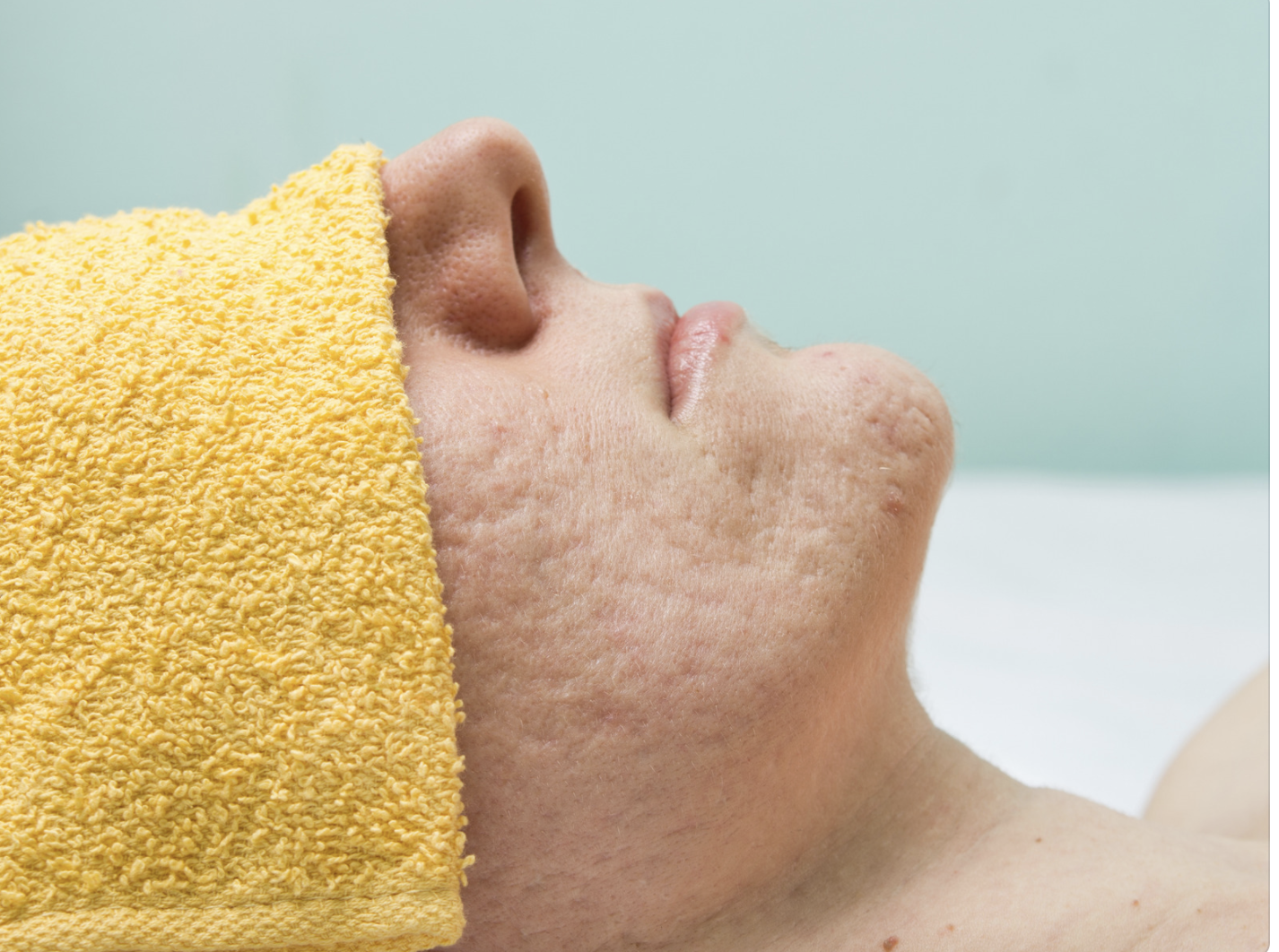 Acne Scar Removal & Treatment