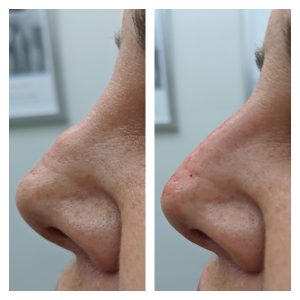 juvederm before and after