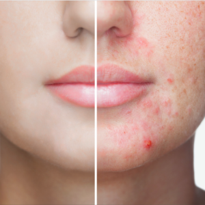 Before and After acne treatment in Hollywood, FL