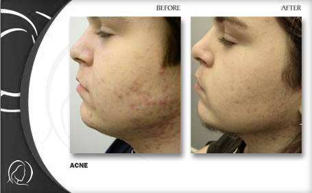 before and after acne treatment Hollywood FL