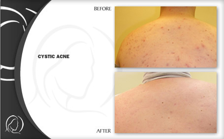 before and after treatment for cystic acne on back in Hollywood FL