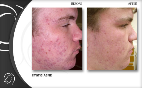 before and after cystic acne treatment Hollywood FL