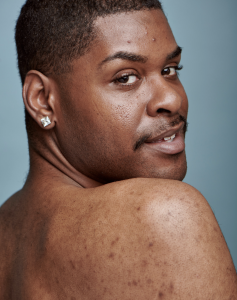 Hyperpigmentation treatment for dark skin in Hollywood FL