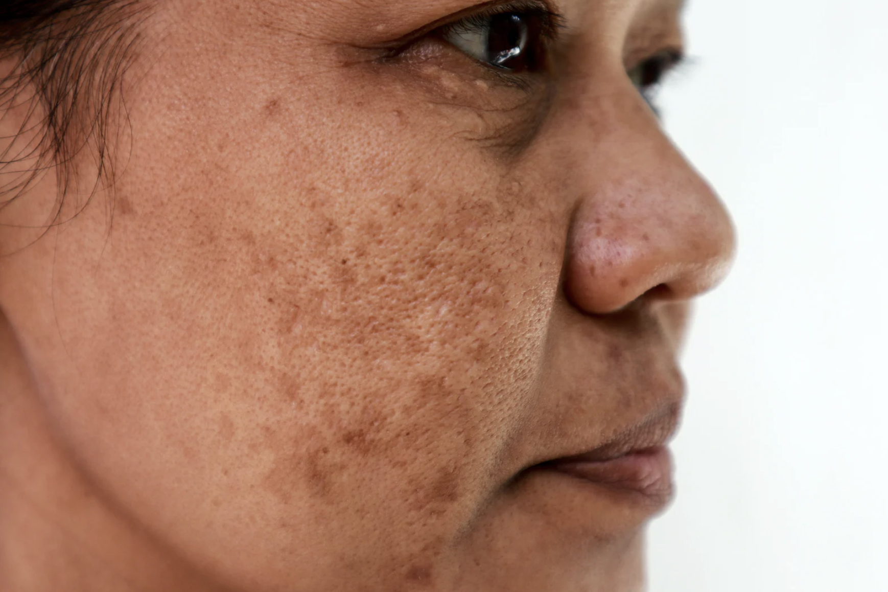 Melasma treatment near Hollywood FL