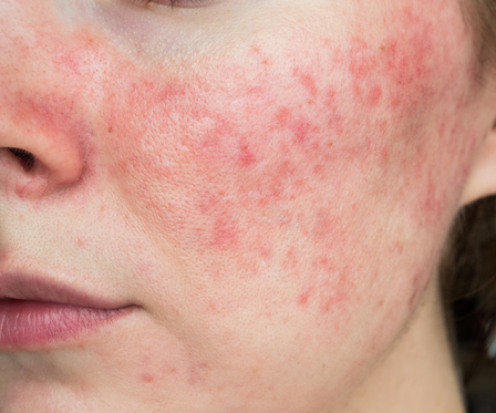 Treatment for Rosacea Near Me