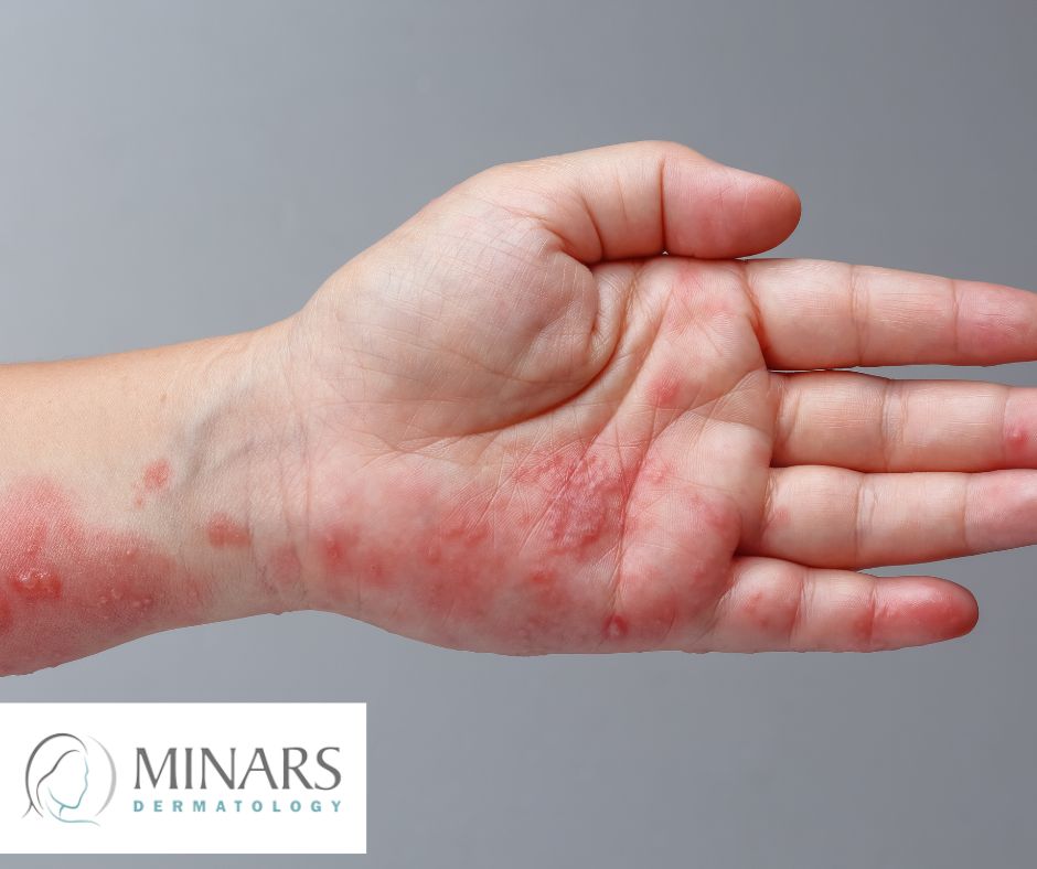 shingles rash hollywood fl dermatologist minars dermatology (1)