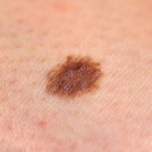 abcdes of melanoma signs of skin cancer