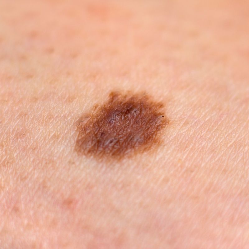abcdes of melanoma signs of skin cancer