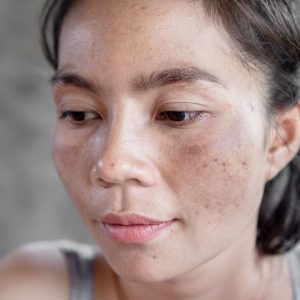 minars hyperpigmentation - Treatment