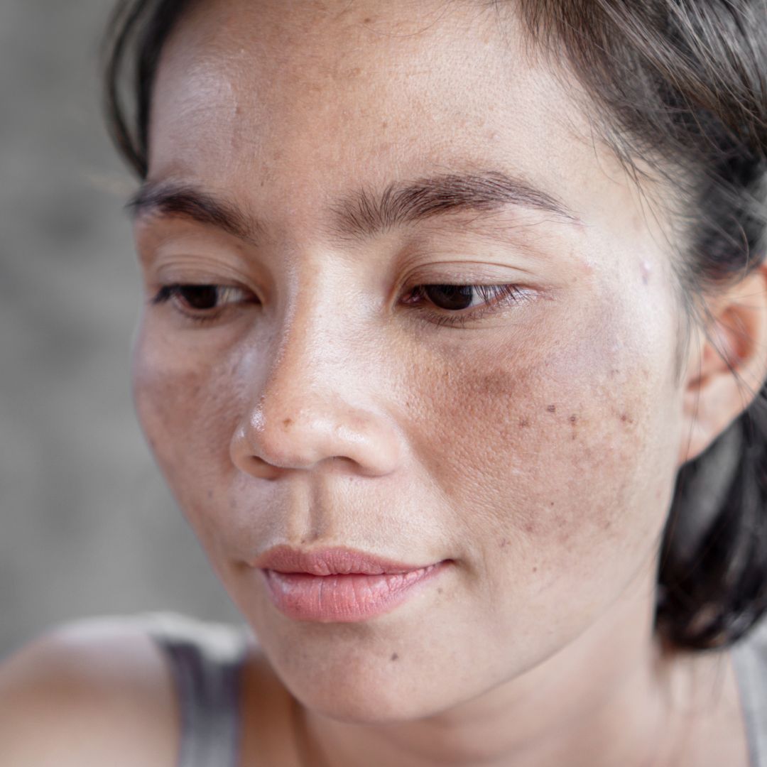 minars hyperpigmentation - Treatment