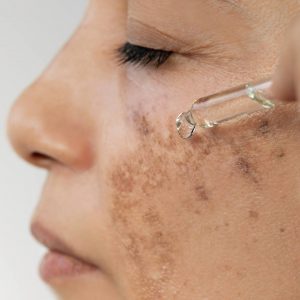 _minars Post-Inflammatory Hyperpigmentation; Dark Spots After Skin Injury and How to Treat Them what casuess PIH