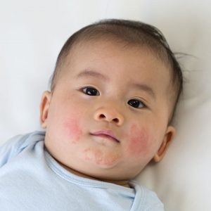 _minars common pediatric skin conditions