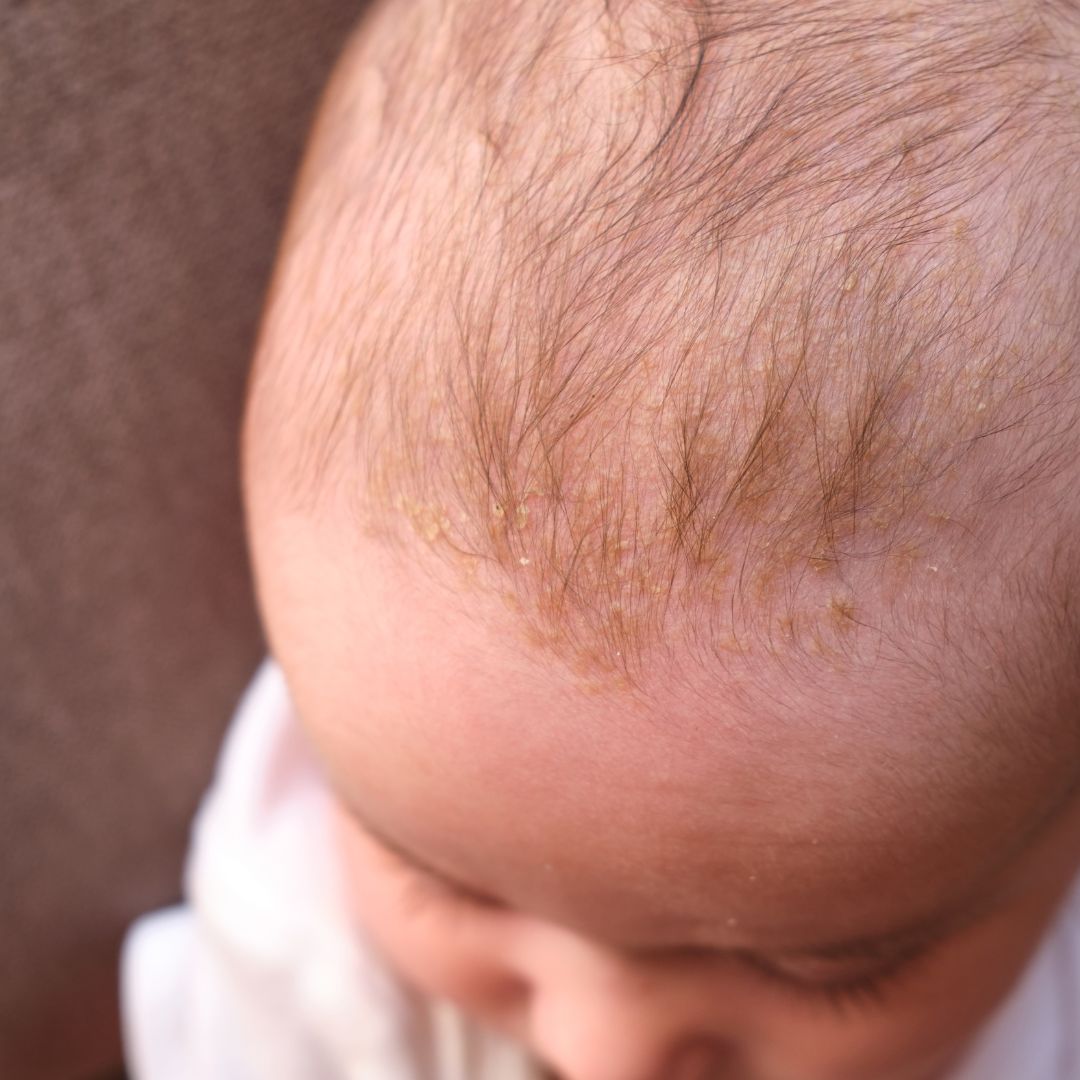 minars common pediatric skin conditions how to treat cradle cap