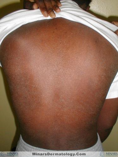 AGEP 2 amoxicillin2