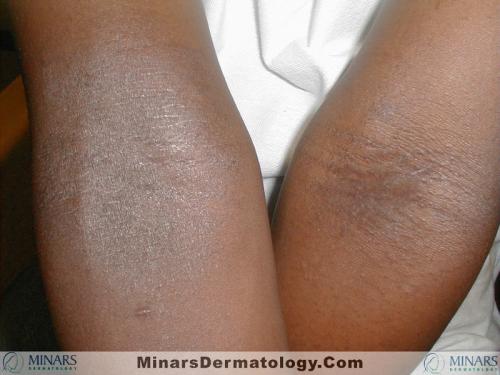Atopic Eczema A