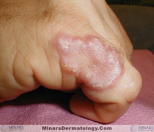 Atypical Mycobacteria A