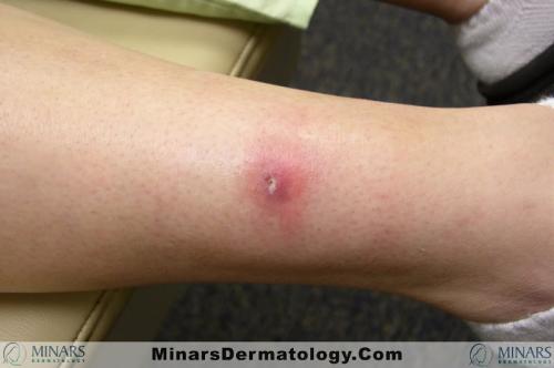 Atypical Mycobacteria furunculosis A
