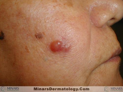 B cell Lymphoma A