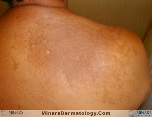 Becker's Nevus A