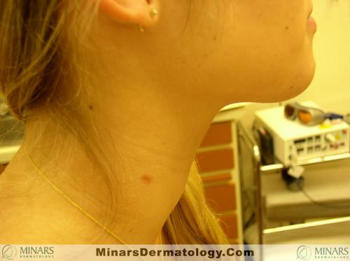 Branchial Cleft CystsA