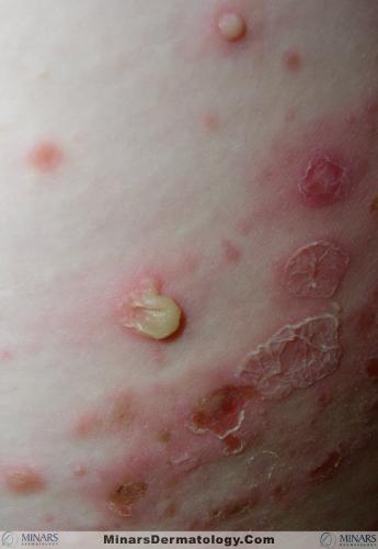 Bullous Impetigo A