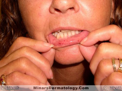 CREST syndrome000