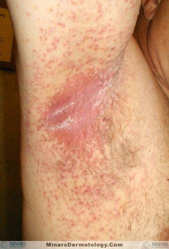 Candidiasis A