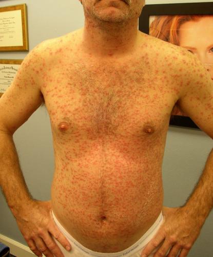 Chicken pox3-6-2006 9-48-23 AM 0001