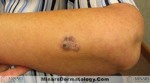 Chromoblastomycosis A