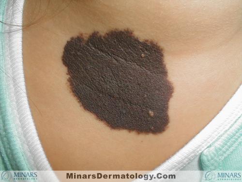 Congenital Nevus A