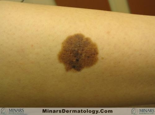 Congenital Nevus b