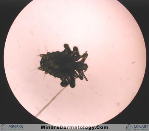 Crab louse A