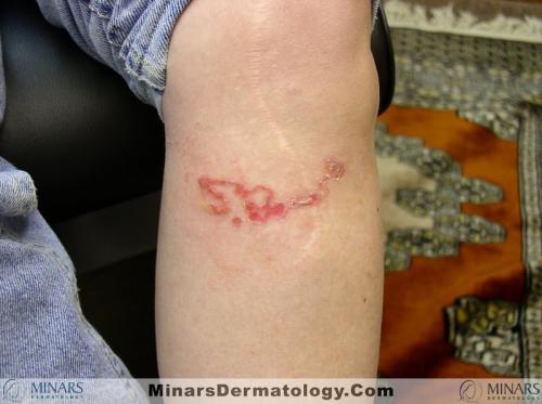 Cutaneous Larva Migrans1