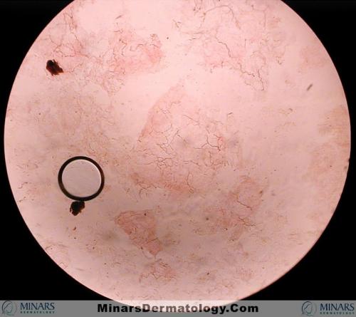 Dermatophyte KOH A